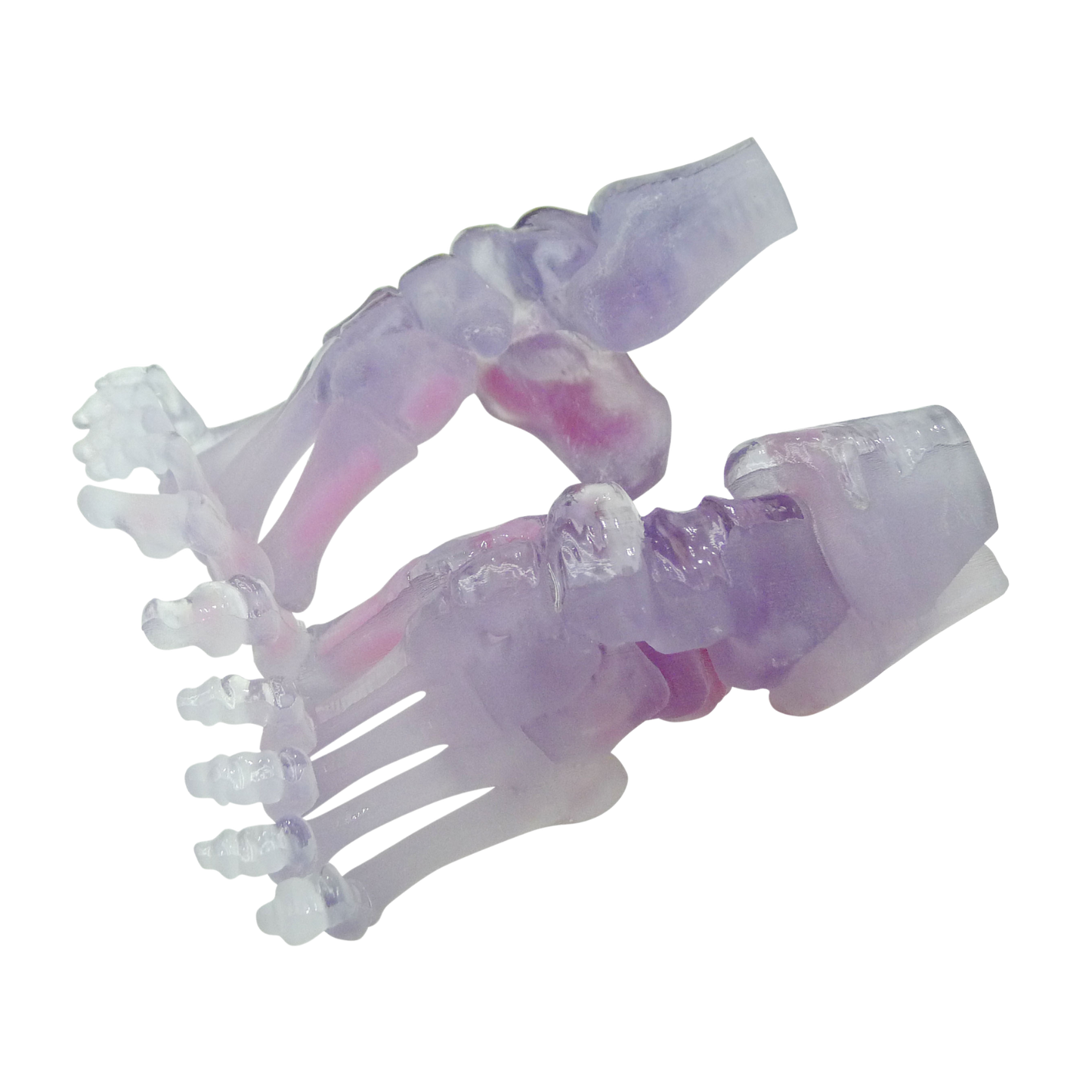 Talipes Equinovarus