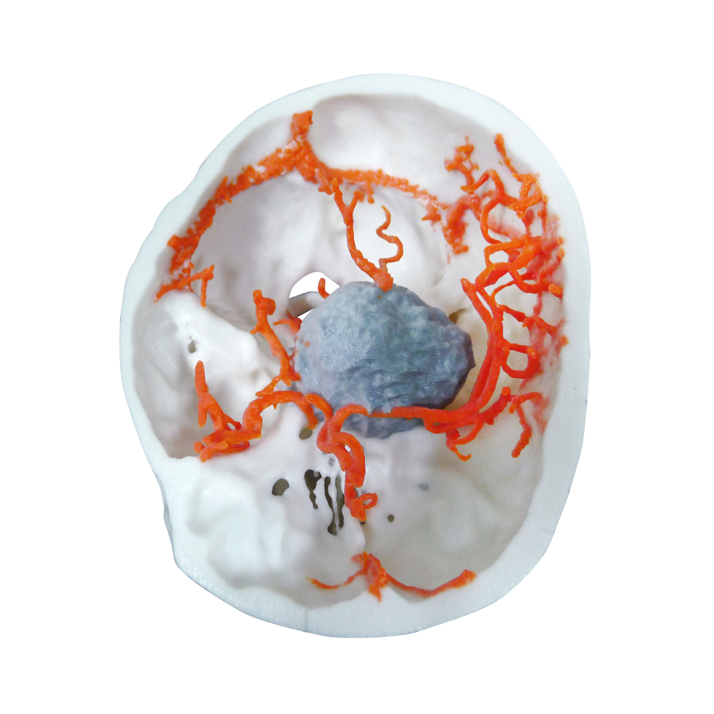 Tumor Intracraneal