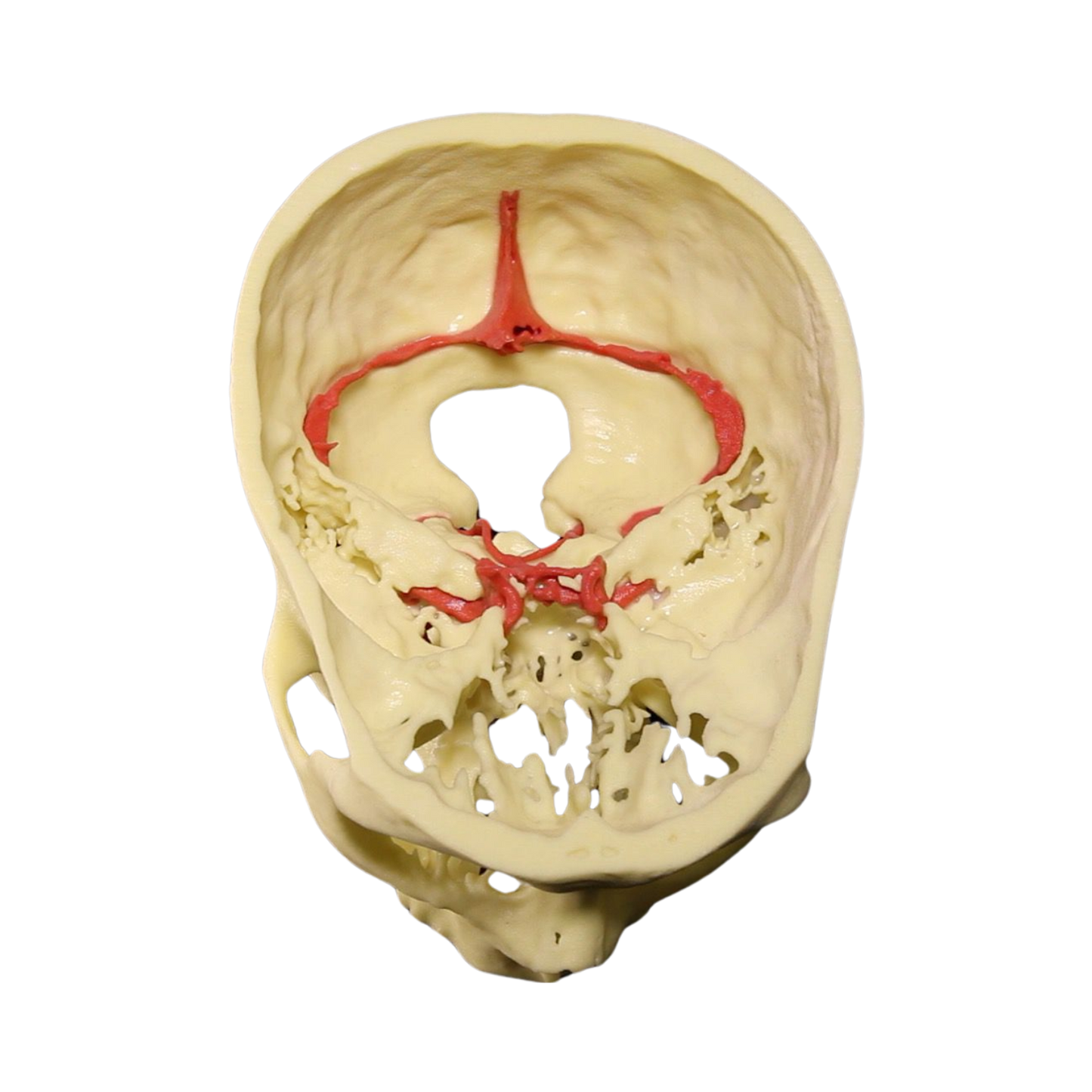 Aneurisma Intracraneal