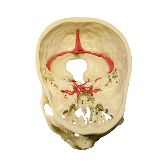 Aneurisma Intracraneal