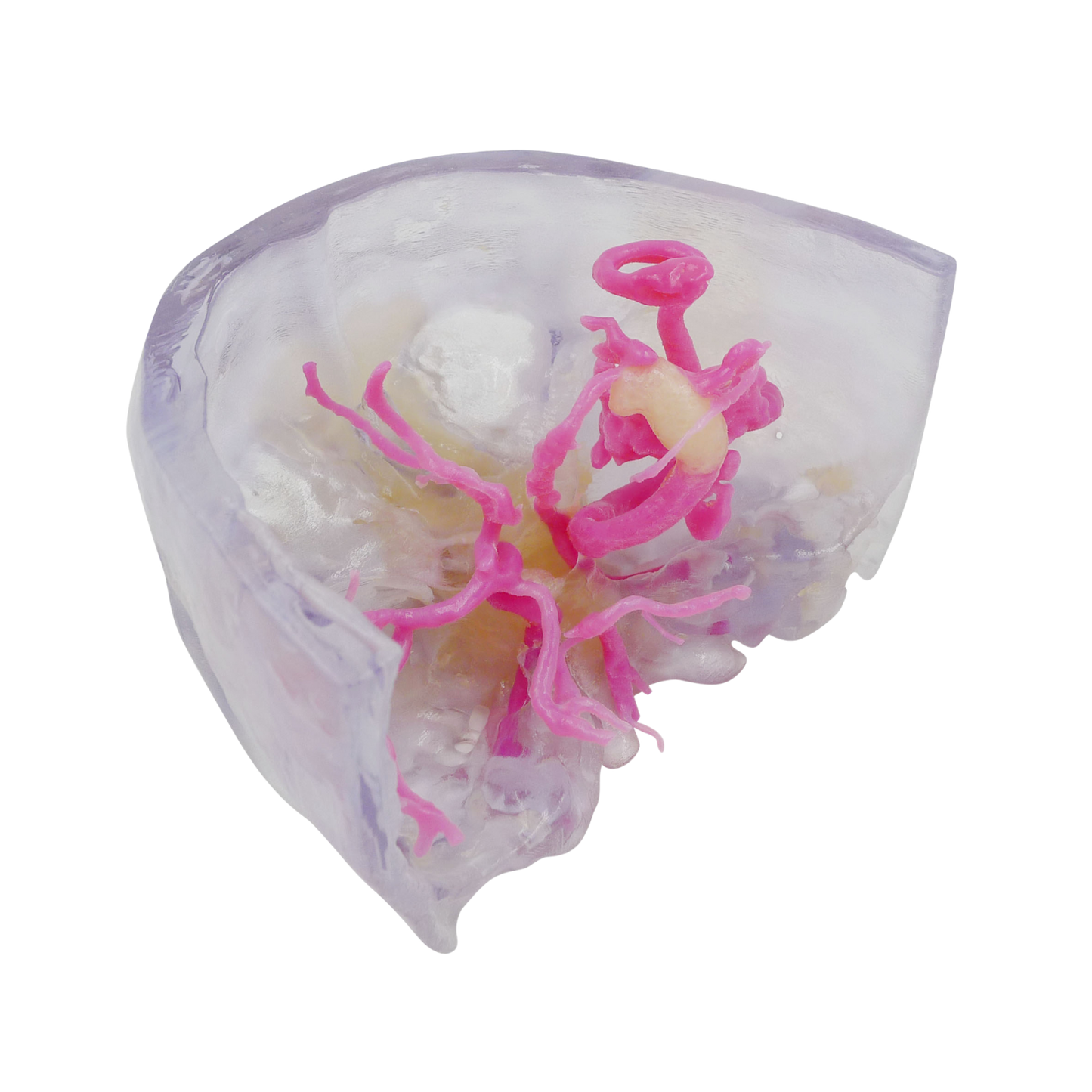 Aneurisma Intracraneal