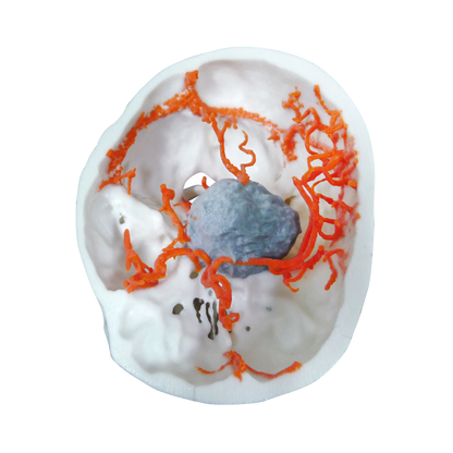 Tumor Intracraneal
