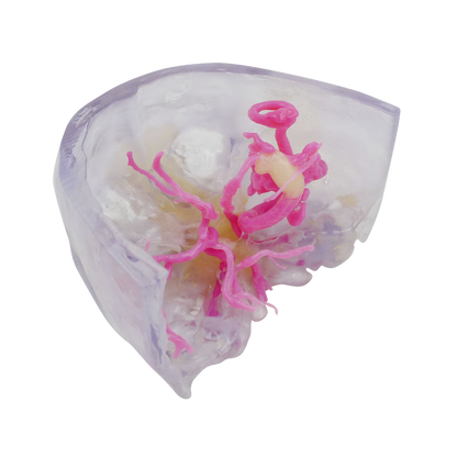 Aneurisma Intracraneal