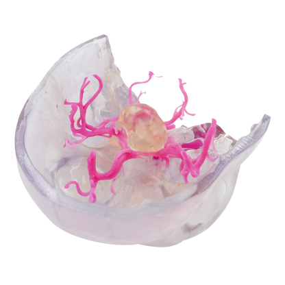 Tumor Intracraneal